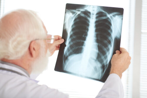 A person holds a chest X‑ray up to the light while examining it.
